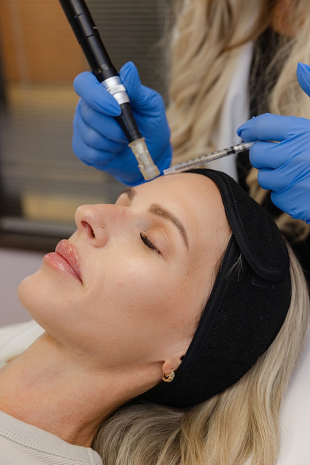 Microneedling treatment session in progress.