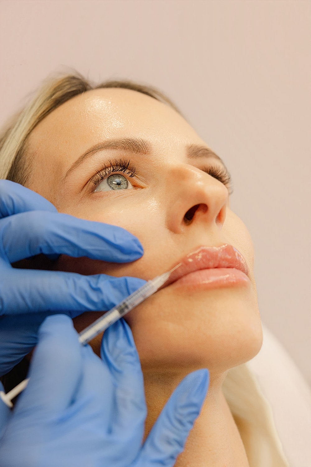 Lip filler injection procedure in progress