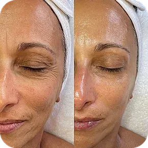 Before and after facial treatment comparison.