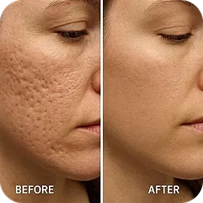 Skin improvement before and after treatment.